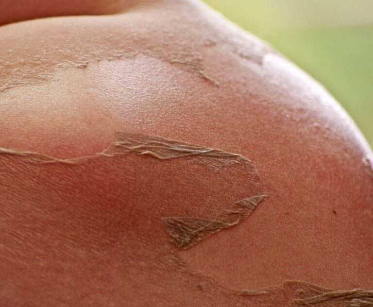 How to Repair Your Skin After Outdoor Sun Exposure: Tips for a Healthy Glow