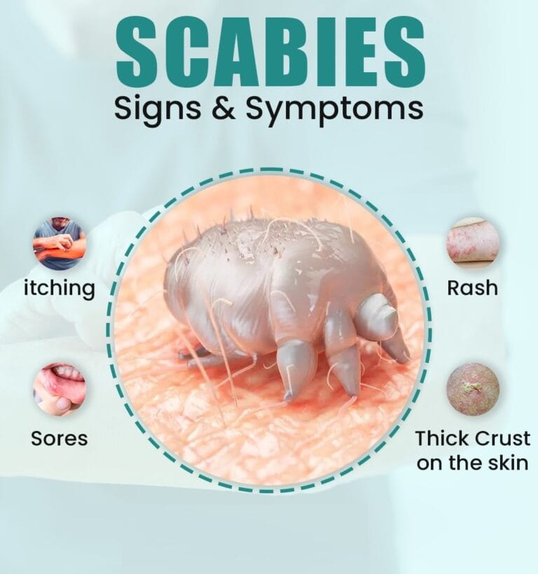 Does Clorox Kill Scabies? A Clear-Cut Guide to Disinfection